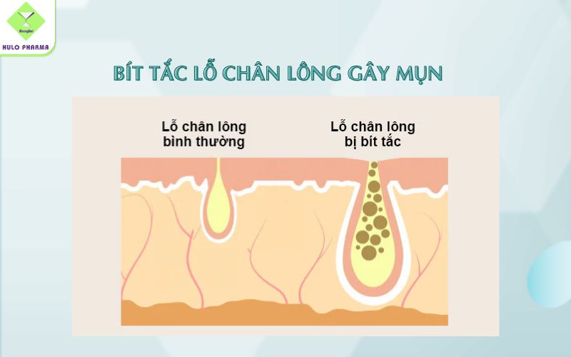 Lỗ chân lông bị bít tắc là nguyên nhân chính gây mụn