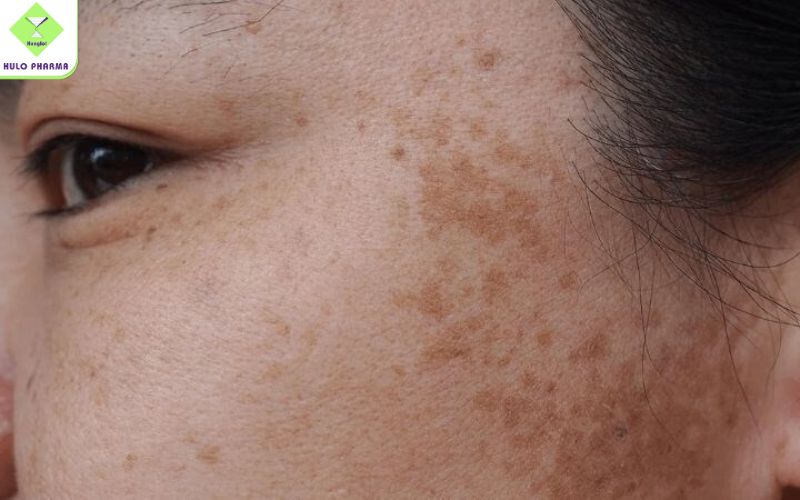 Vì sao da nám cần dùng kem chống nắng?