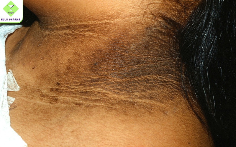 Gai đen là tình trạng da có các nốt sần li ti hoặc những mảng nhỏ có màu tối