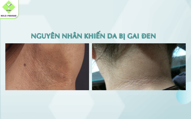 Nguyên nhân khiến da bị gai đen