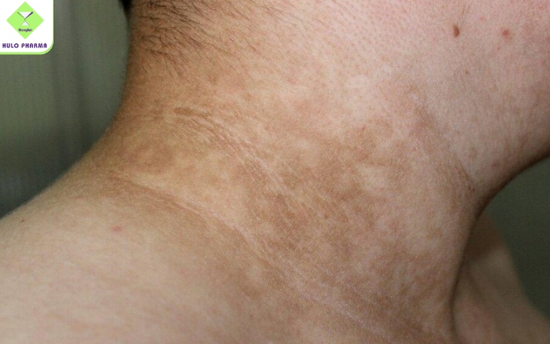 Cách làm sáng vùng cổ bị đen cho bé