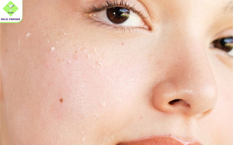 Hiện tượng “ra ghét” khi bôi kem chống nắng