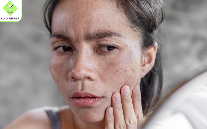 Các nguyên nhân khiến da bị đen, tăng sắc tố