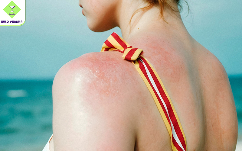 Hạn chế tình trạng da bị cháy nắng