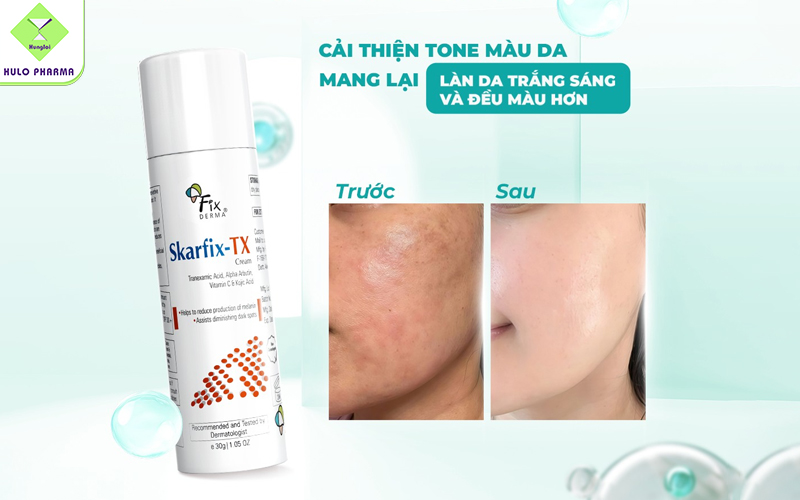 Skarfix – TX Cream giúp cải thiện tình trạng tăng sắc tố
