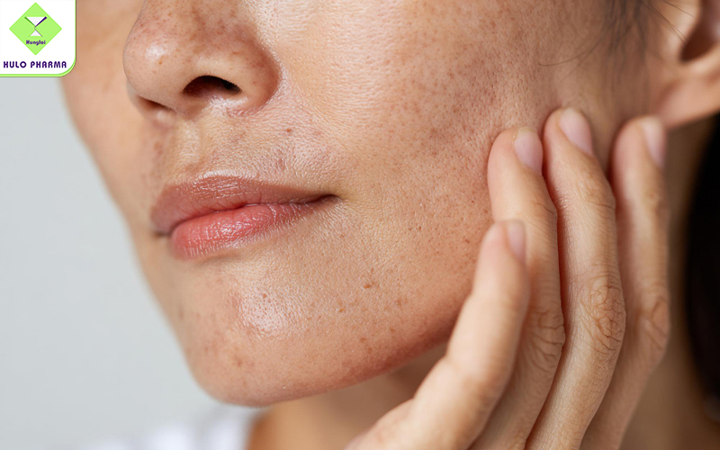 Da thâm sạm nên dùng kem chống nắng và vitamin C