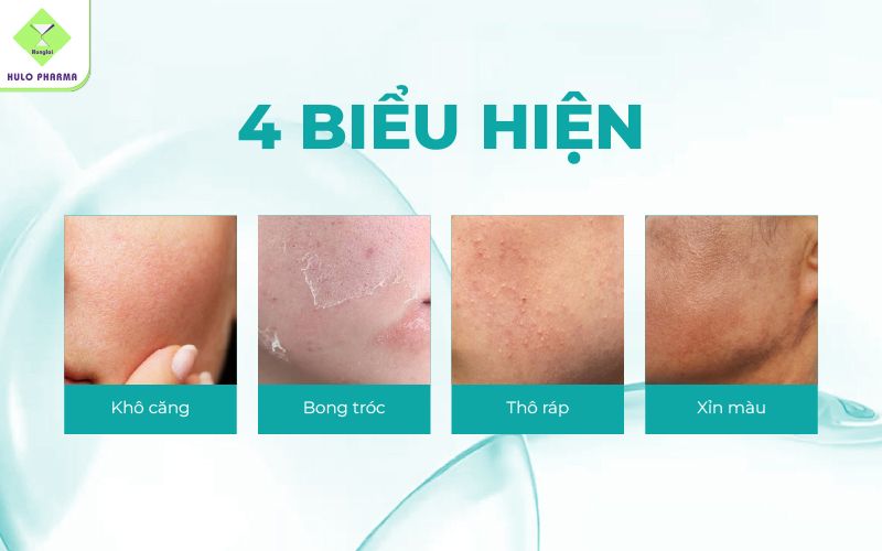 Dấu hiệu cảnh báo làn da đang thiếu dưỡng ẩm trầm trọng